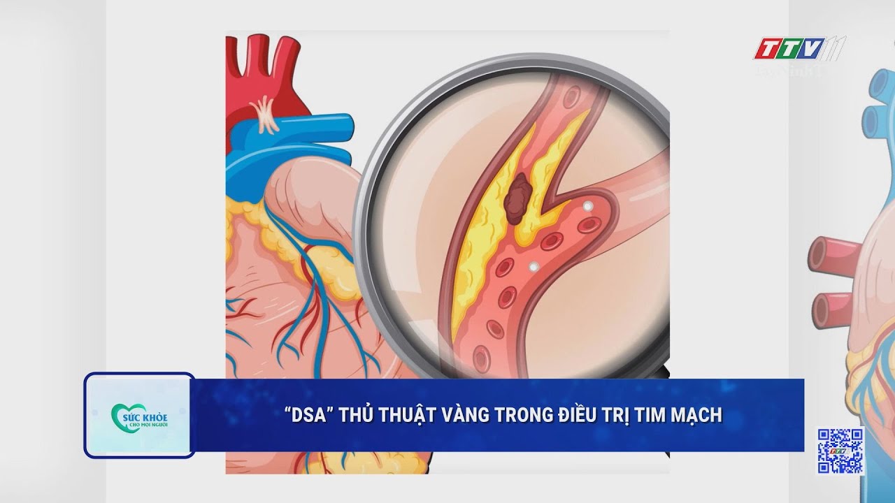 “DSA” thủ thuật vàng trong điều trị tim mạch | SỨC KHỎE CHO MỌI NGƯỜI | TayNinhTV